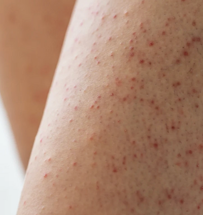 PORES