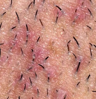 INGROWN HAIRS