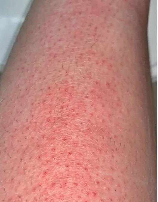 Before treatment