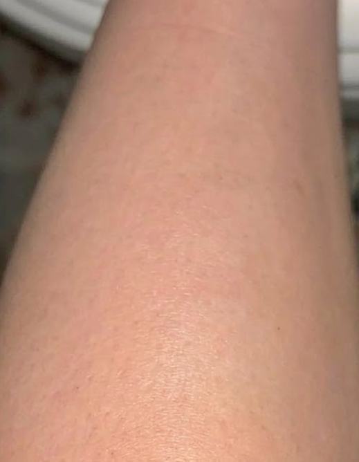 After treatment